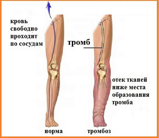 Профилактика тромбоза глубоких вен у пациентов с COVID-19 с помощью прессотерапии